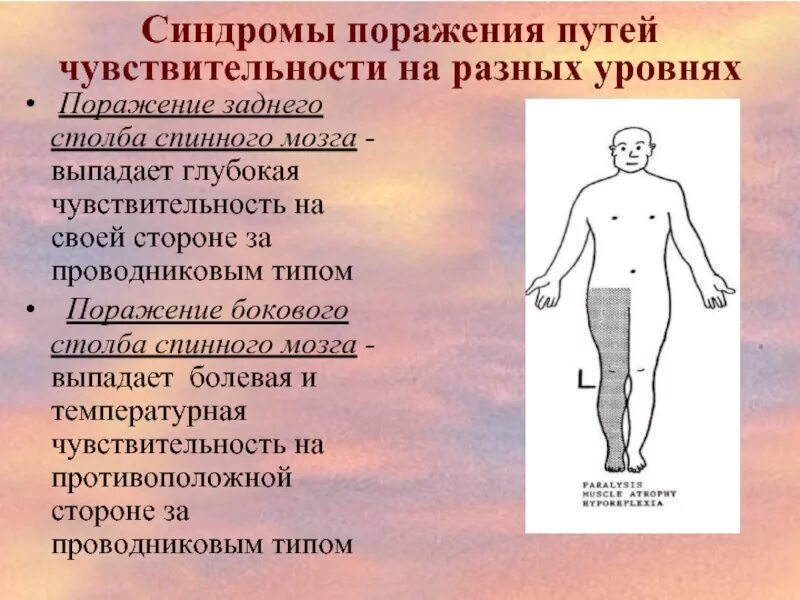 Периферический корешковый тип. Типы нарушения чувствительности. Сегментарный диссоциированный тип расстройства чувствительности. Чувствительность и типы нарушения чувствительности. Периферический полиневритический тип нарушения чувствительности.