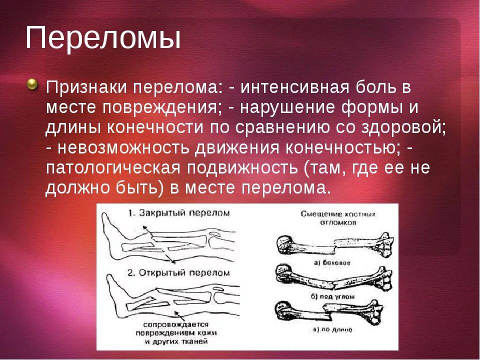 Переломы костей презентация.