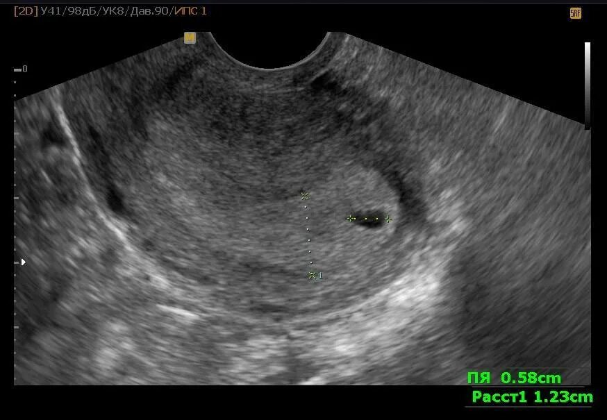 УЗИ 5.5мм околоплодное яйцо. Плодное яйцо в матке УЗИ. Ложное плодное яйцо на УЗИ. УЗИ плодное яйцо в матке 4 недели. Через четыре недели