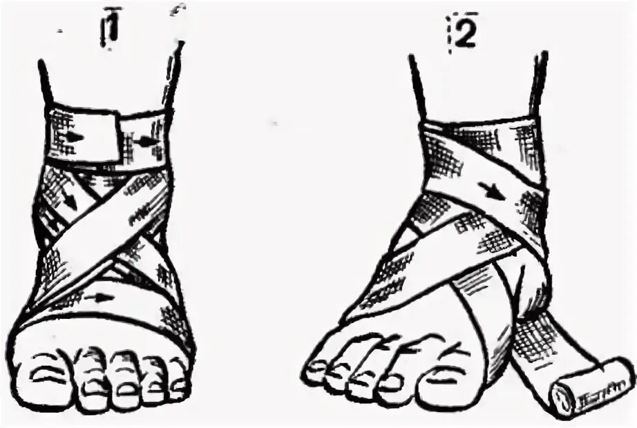 Восьмиобразная повязка на голеностопный сустав. Восьмиобразная повязка на голеностоп техника. Крестообразная восьмиобразная повязка на стопу алгоритм. Повязка на голеностопный сустав восьмиобразная техника наложения.