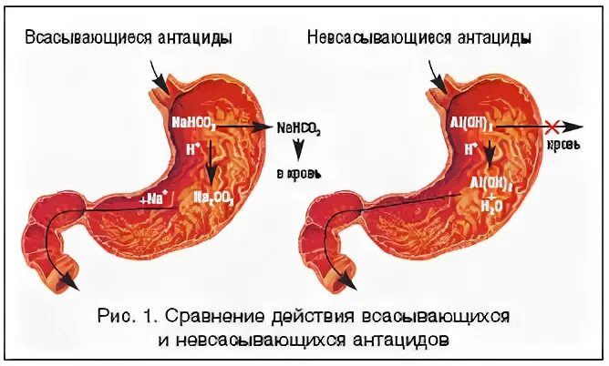 Побочные эффекты алюминийсодержащих антацидов. Механизм действия всасывающихся антацидов. антациды всасывающиеся и невсасывающиеся. не всасывающиеся антациды. невсасывающиеся антациды механизм действия.