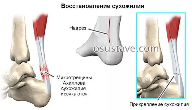 Achilles Tendonitis - Symptoms & Causes Mount Elizabeth Hospitals