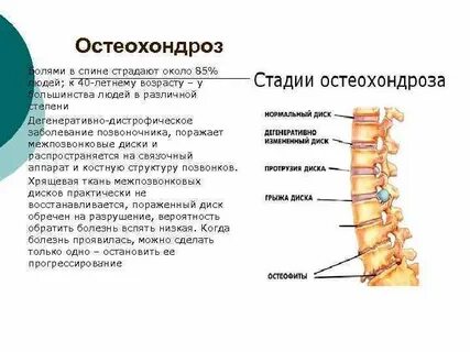 Остеохондроз позвоночника острый период