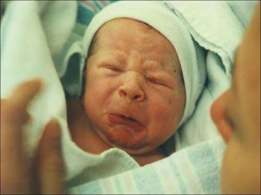 Доношенный новорожденный. Асфиксия новорожденных. Асфиксия новорожденных сестринский. Асфиксия новорожденного фото.