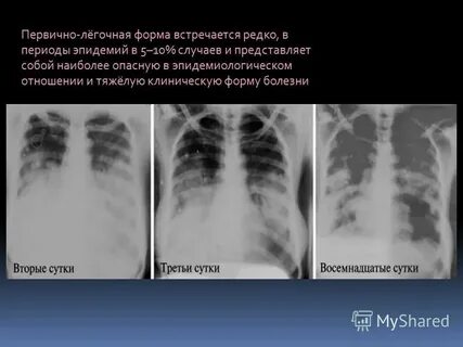 Легочная форма чумы