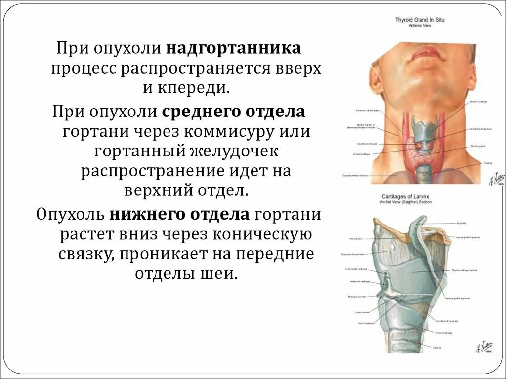 Новообразования гортани.