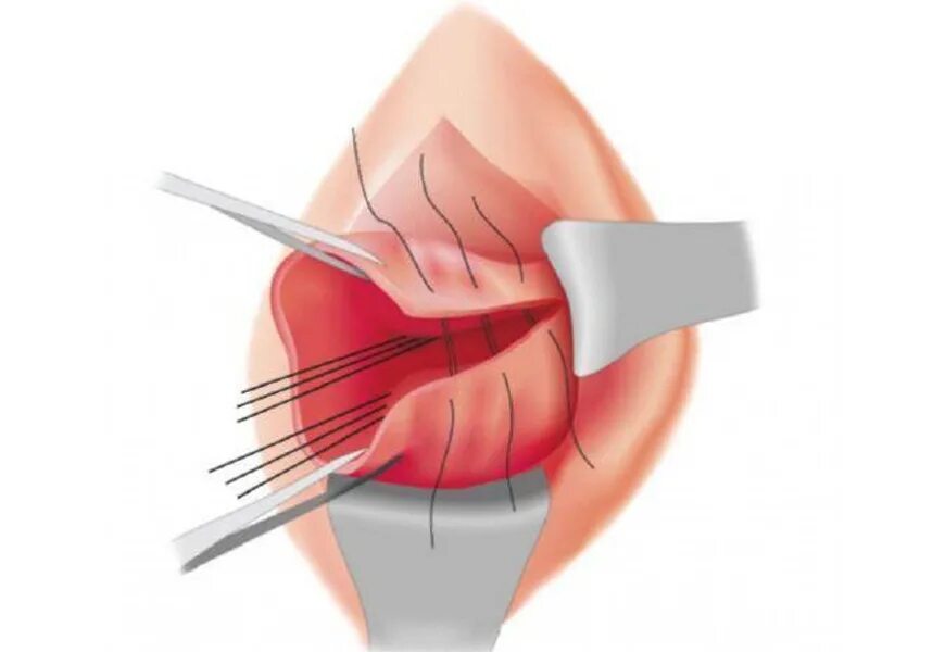 Ушивание разрывов. Ушивание разрывов мягких тканей родовых путей. Рассечение шейки матки. Ушивание разрыва шейки матки.