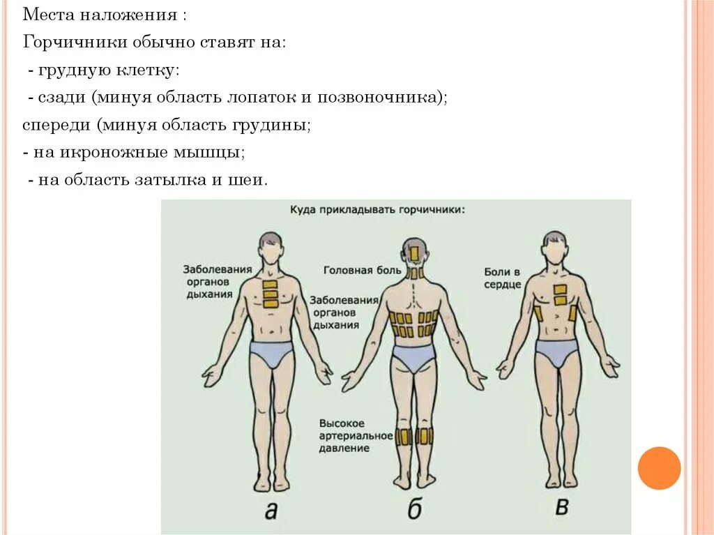 Сколько держать горчичники на спине. Схема постановки горчичников при бронхите. Места постановки горчичников. Горчичники схема наложения.