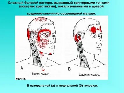 Грудино ключично сосцевидная мышца боль