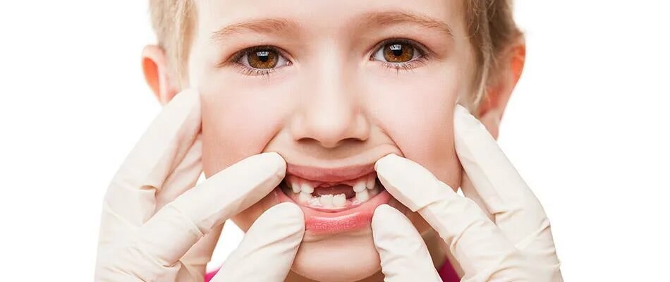 Если шатается зуб у ребенка. Молочные зубы шатаются у детей. Сильно шатается зуб что делать