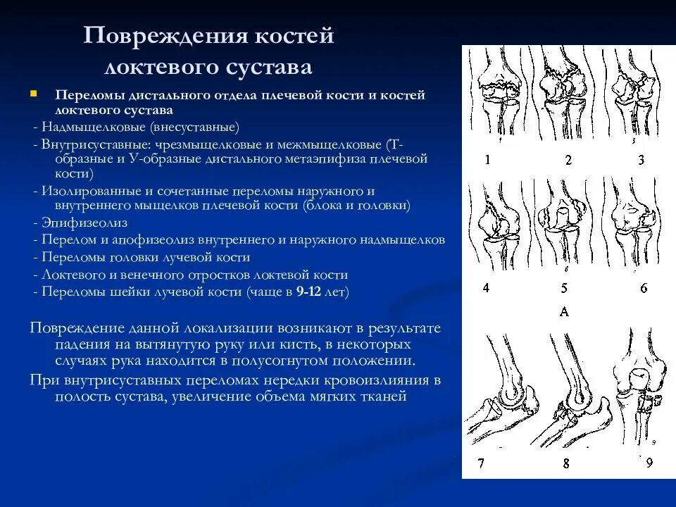 Разрыв кости. Переломы костей локтевого сустава классификация. Перелом проксимального отдела локтевой кости. Переломы дистального отдела локтевой костей. Переломовывих локтевого сустава.