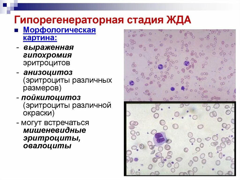 Гипохромия железодефицитная анемия. Регенераторная гиперрегенераторная анемия.  Гипохромия  микроциты  анизоцитоз  пойкилоцитоз. Жда анизоцитоз пойкилоцитоз. Картина крови при железодефицитной анемии.