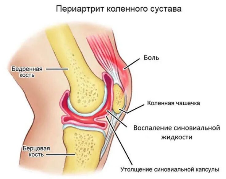 Боль под коленом спереди. Синовит колена коленного сустава. Симптомы периартрита коленного сустава. Супрапателлярный выпот. Синовит синовиальная оболочка.