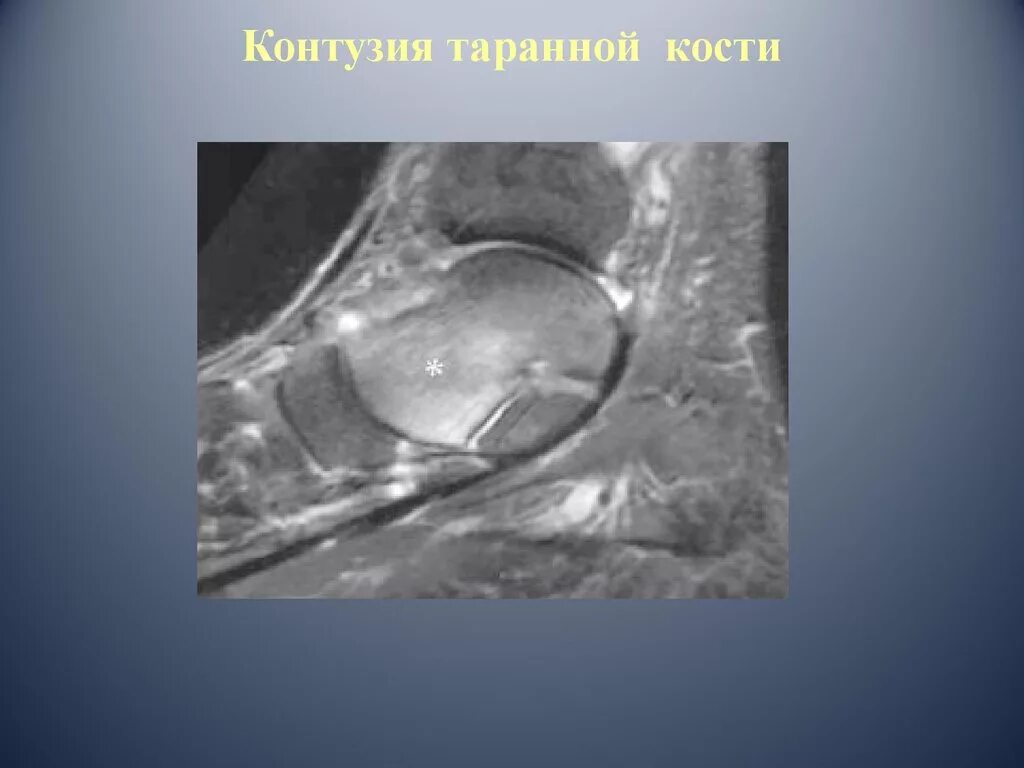 Что такое контузия словами и последствия. Контузия таранной кости. Контузионные изменения таранной кости. Контузионные изменения кости мрт.