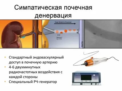 Почечная денервация