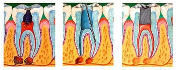 Фиброзный периодонтит. Периодонтита 3 канального зуба. Корневой канал при воспалении пульпы пломбируют. Хронический фиброзный периодонтит. Зуб мышьяк периодонтит.