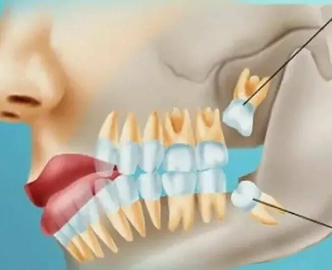 Прорезывающийся зуб мудрости. Как долго растут зубы мудрости