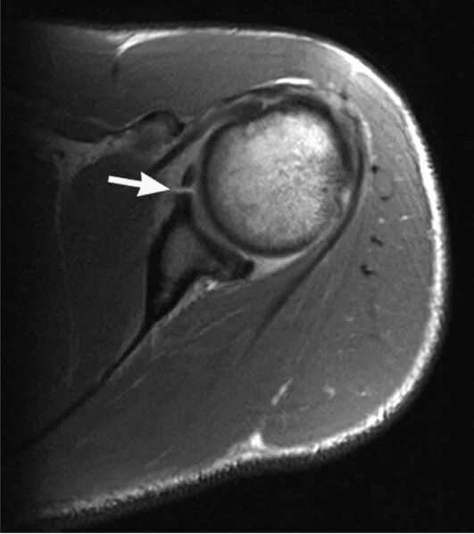 Разрыв суставной губы гленоида плечевого. Повреждения суставной губы гленоида лопатки. Надрыв суставной губы плечевого сустава мрт. Повреждение Банкарта плечевого сустава мрт.