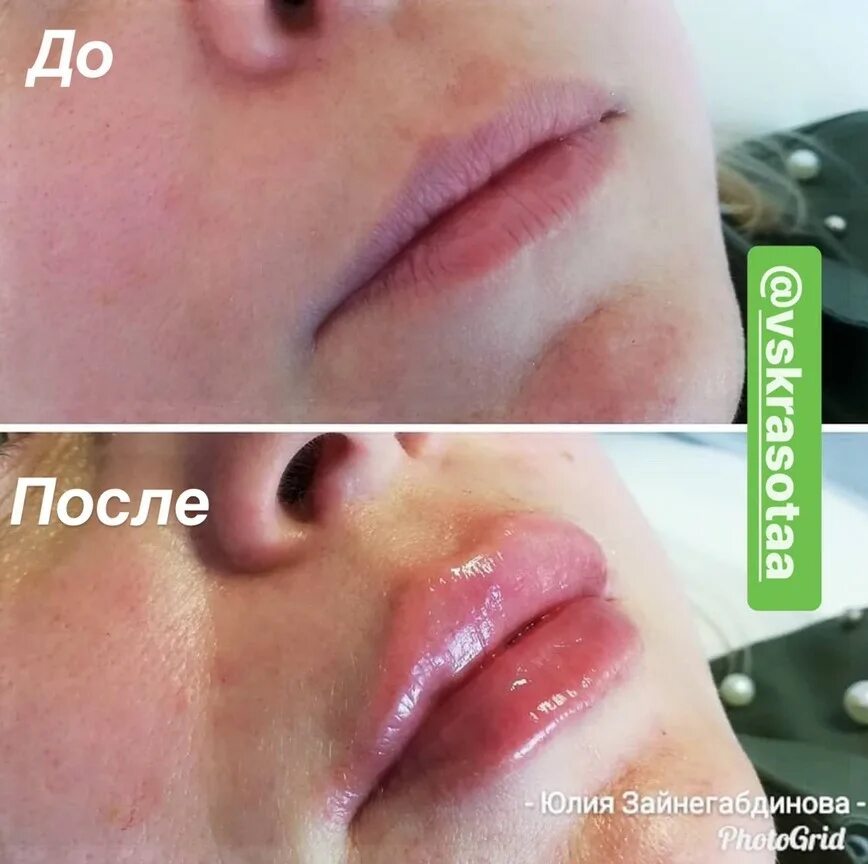 Французские губы до и после Вареники губы Вопросы и ответы