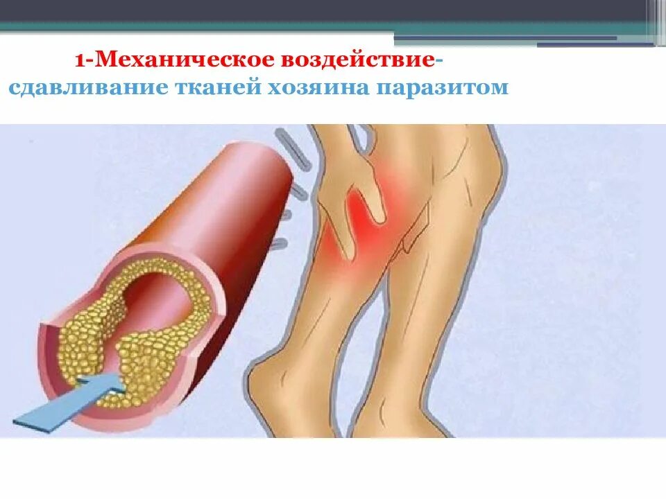 Признаки атеросклеротического поражения артерии. Облитерирующий атеросклероз сосудов нижних конечностей. Облітеруючий атеросклероз. Облитерирующий атеросклероз симптомы. Облитерирующий атеросклероз артерий нижних конечностей симптомы.