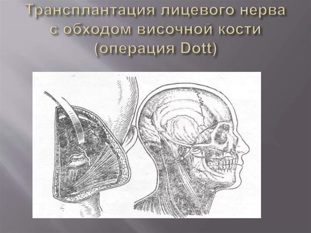 Паралич лицевого нерва неврология. НЕЙРОПЛАСТИКА лицевого нерва. Трансплантация лицевого нерва.