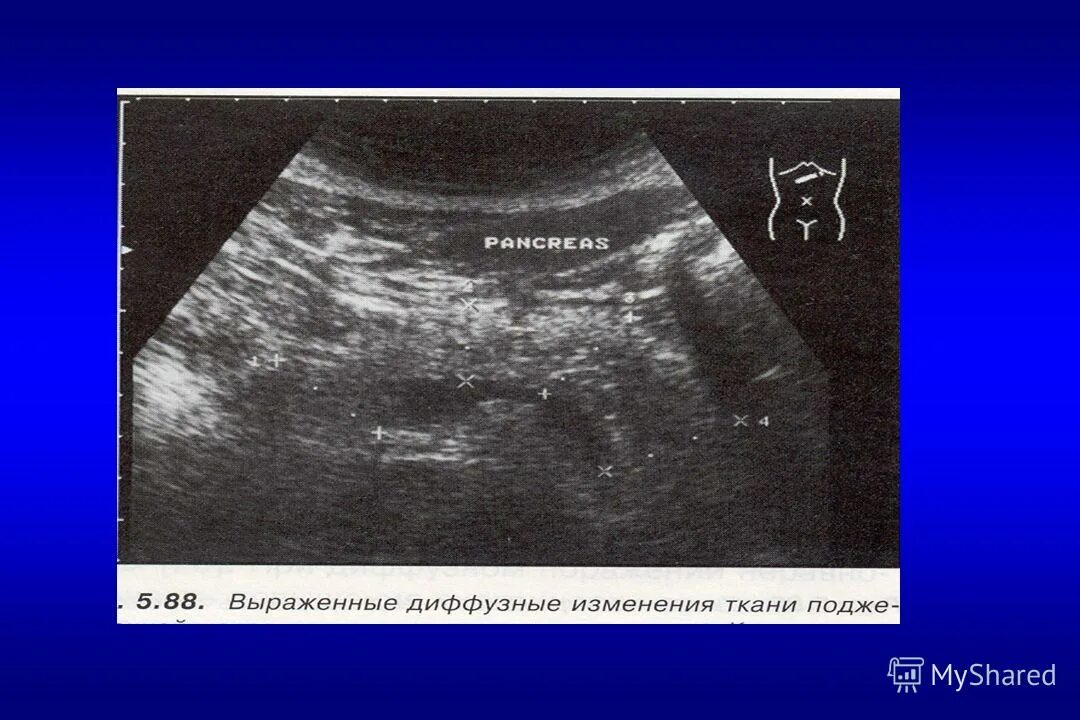 Диффузно однородная. Хронический панкреатит УЗИ. Диффузные изменения поджелудочной железы на УЗИ. Псевдотуморозный панкреатит на УЗИ. Панкреатит на УЗИ.