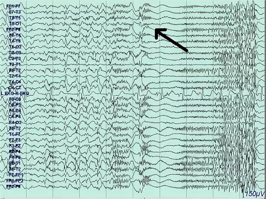 Синдром Леннокса-Гасто ЭЭГ. ЭЭГ при эпилепсии. Спайки на ЭЭГ. Спайк волны на ЭЭГ при миоклонии. Спайк на ээг