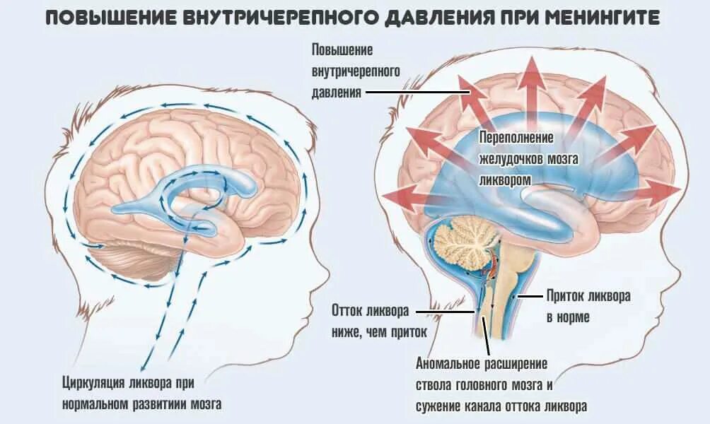 Внутри черепной давления симптомы. Повышение внутричерепного давления патогенез. Этиология синдрома повышения внутричерепного давления. Gidrocefaliya головного мозга. Расширенные ликворные пространства