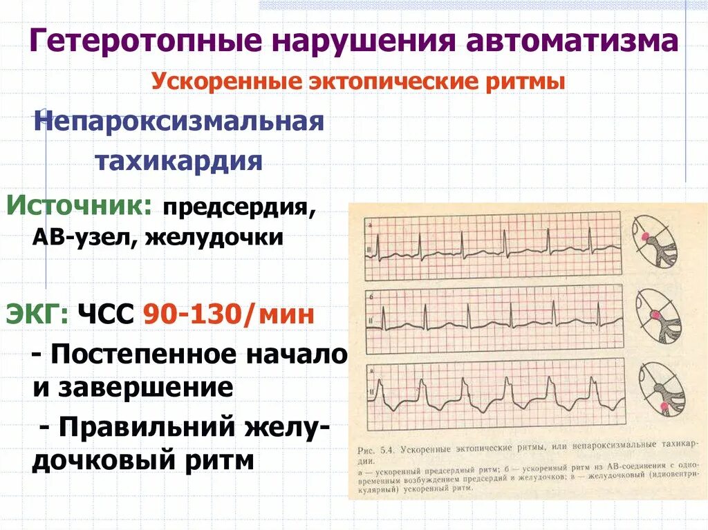 Нарушение предсердного ритма
