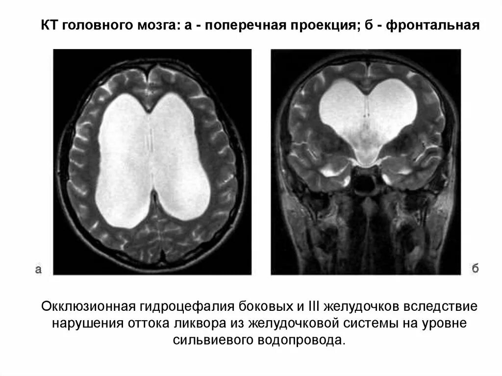 Неокклюзионная гидроцефалия. Наружная гидроцефалия головного мозга кт. Окклюзионная тривентрикулярная гидроцефалия. Симптомы острой окклюзионной гидроцефалии. Окклюзионная гидроцефалия мрт.