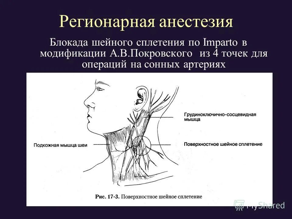 Блокада сплетения. Межлестничная блокада плечевого сплетения методика. Шейная блокада анестезия. Анестезия шейного сплетения. Блокада шейного сплетения.