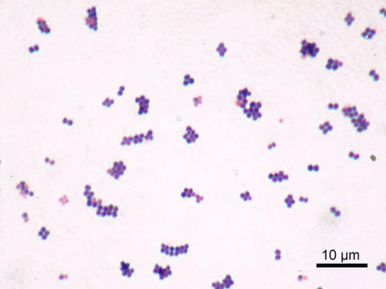 Streptococcus в мазке у мужчин. Стафилококк ауреус микроскопия. Стафилококк ауреус по Граму. Золотистый стафилококк микроскопия. Золотистый стафилококк в мазке.