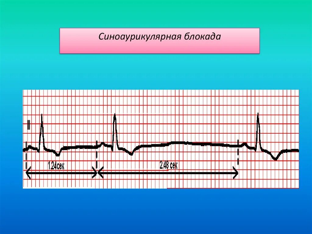 Синоаурикулярная блокада. Синоаурикулярная блокада 2 степени на ЭКГ. Синовертрикулярная блокада. Сино арткулярная блокада. Синоаурикулярная блокада степени.