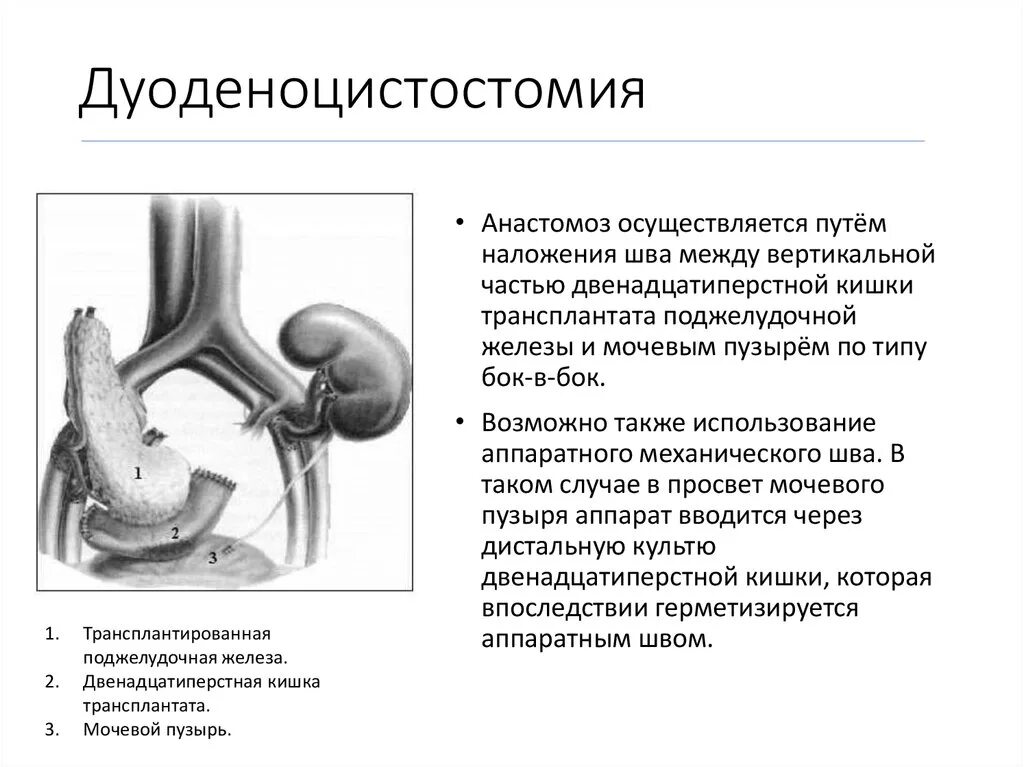Пересадить поджелудочную железу