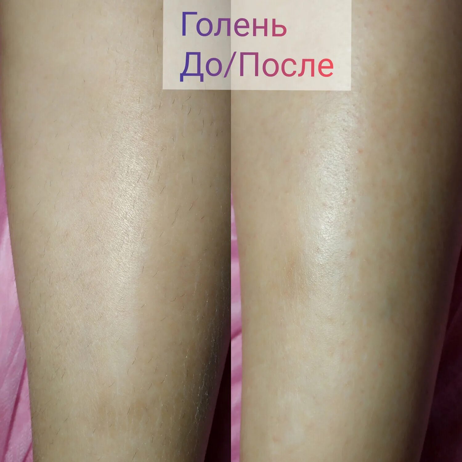 Лазерная эпиляция ноги skinlift ru. Шугаринг голени. Лазерная эпиляция голени. Лазерная эпиляция бедра. Лазерная эпиляция ноги полностью.