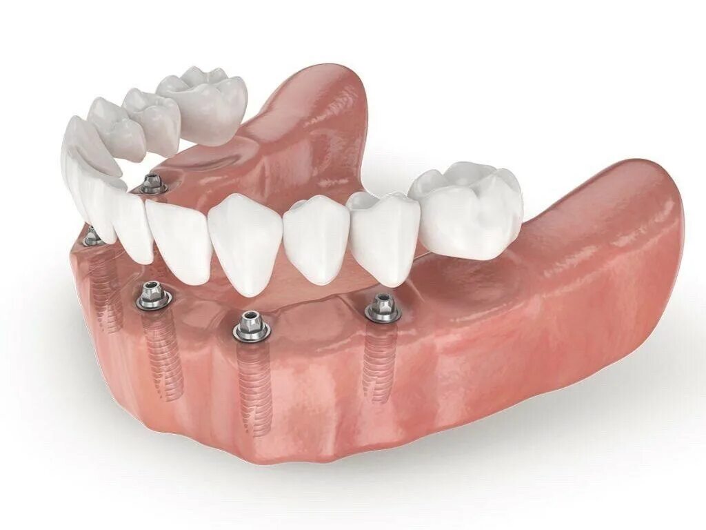 Несъёмный мостовидный протез челюсти. Имплантация челюсти на 6 имплантах. Имплантация челюсти на 4 имплантах. Несъемные зубные протезы на 4 имплантах. Имплантация зубов all on 6