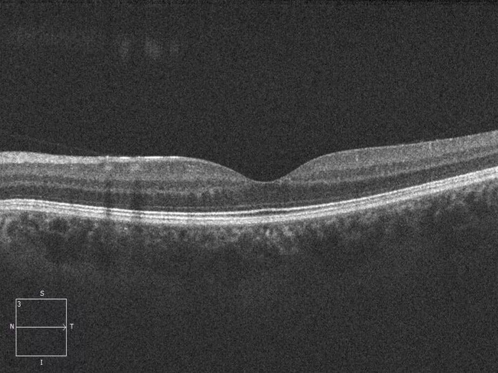 Макулярный отек лечение. Макулопатия макулярный отек. Оптическая когерентная томография диабетический макулярный отек. Диабетический макулярный отек. Кистозный макулярный отек окт.