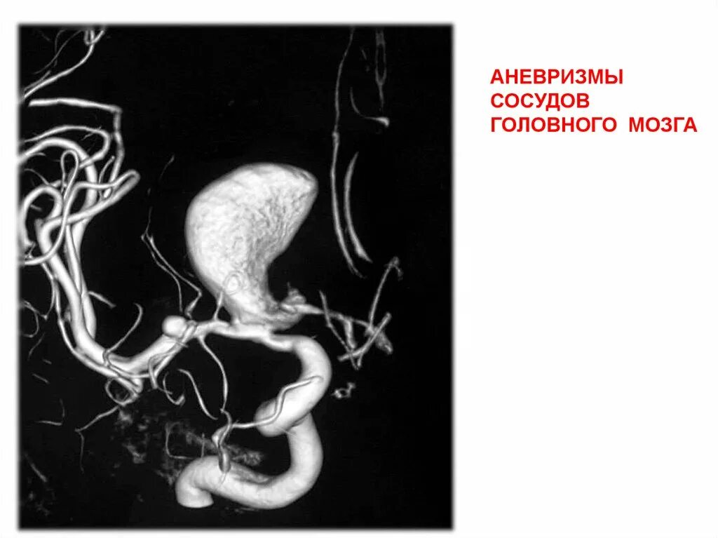 Фузиформная аневризма головного мозга. Ангиография сосудов аневризма. Аневризма артерии головного мозга. Аневризма селезеночной артерии. Аневризма мозга простыми словами