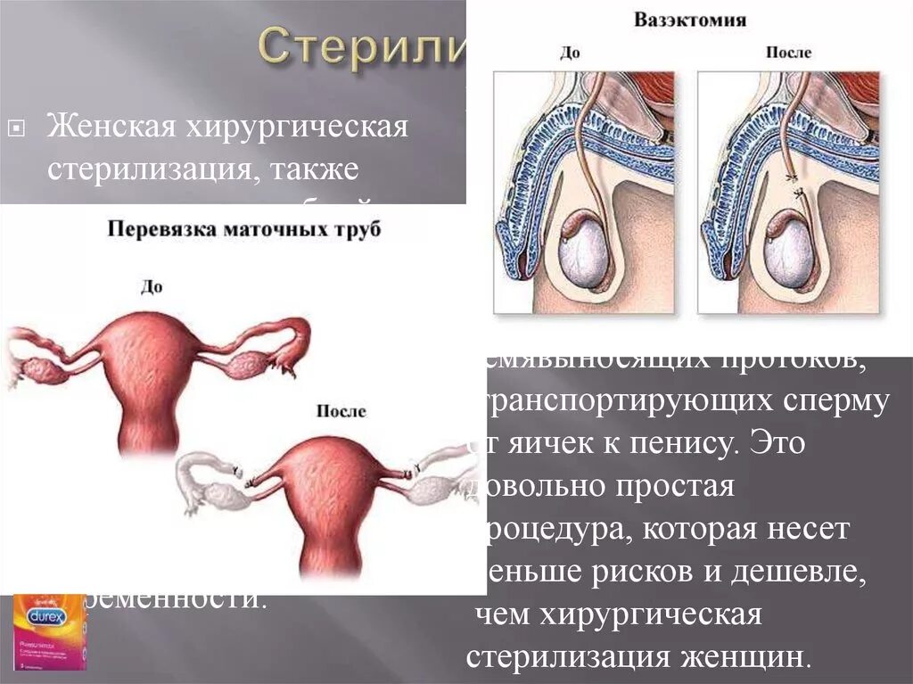 Как перевязывают трубы у женщин. Перевязка маточных труб. Хирургическая стерилизация маточных труб. Перевязка труб операция.