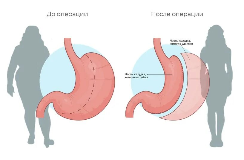 Бариатрическая хирургия это. Бариатрическая операция. Бариатрическая операция на желудке. Бариатрическая хирургия резекция желудка. Бариатрическая операция схема.