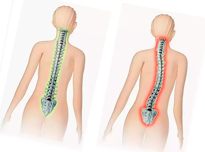 Искривленный позвоночник. Сколиоз позвоночника в левую сторону.