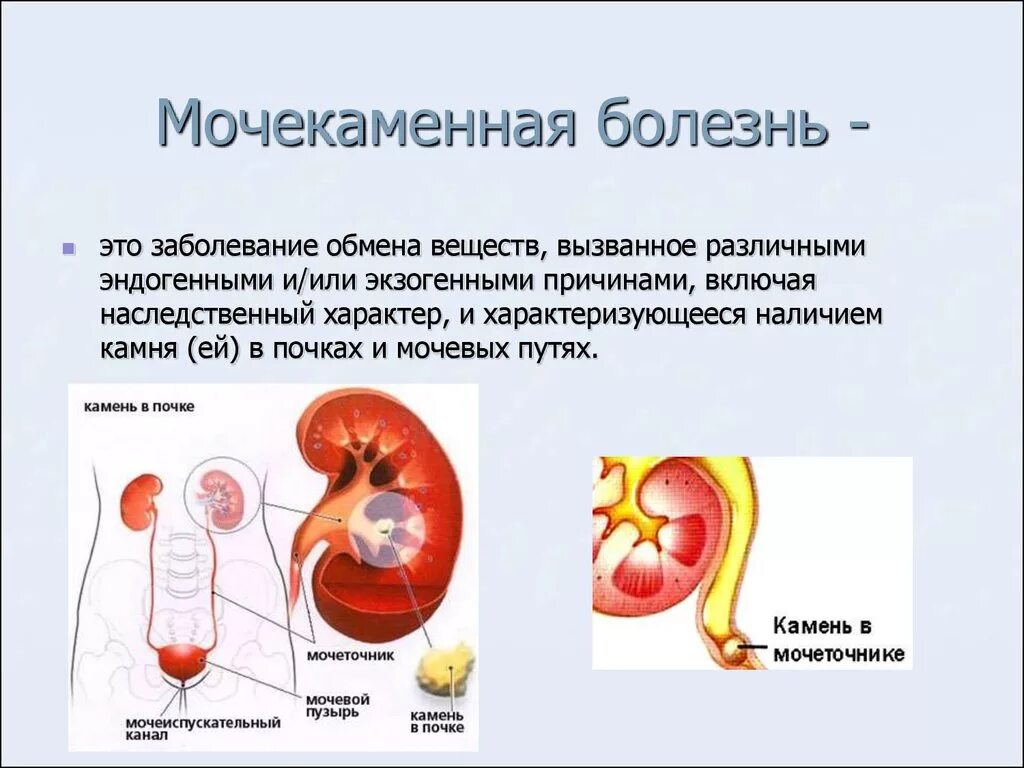 Заболевание почек 6. Заболевания мочевыделительной системы мочекаменная болезнь. Заболевание почек мочекаменная болезнь симптомы. Мочекаменная болезнь (urolithiasis). Моче-КАМНЕННАЯ болезнь.