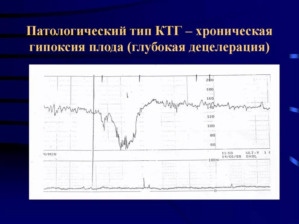 Патологический ктг. Базальный ритм на ктг. Нормальный тип кривой ктг. Патологический тип ктг. Ктг интерпретация результатов.