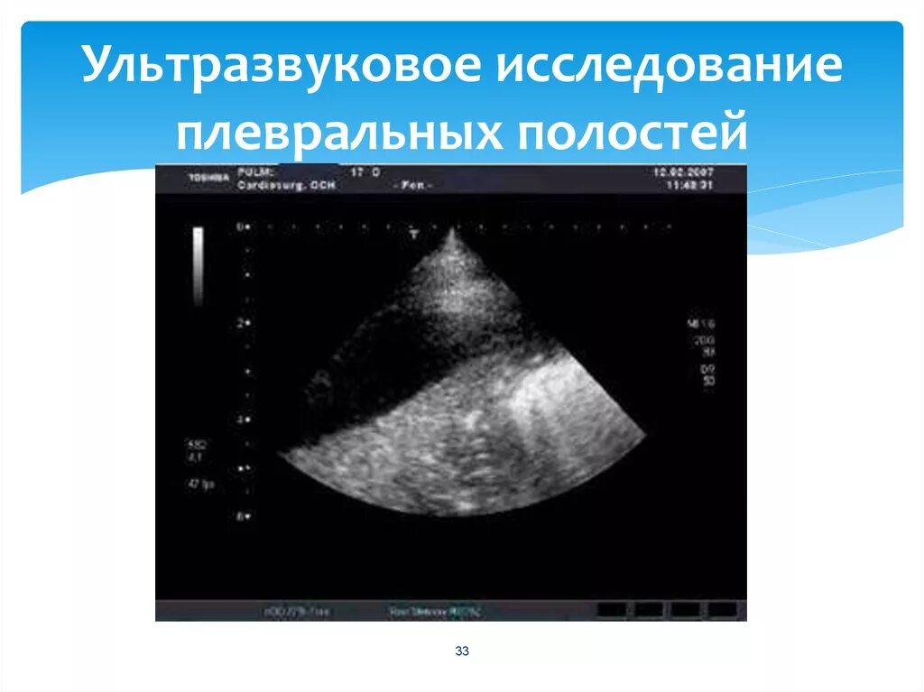 Узи плевральных полостей плеврит. Экссудативный плеврит узи. Ультразвуковое исследование плевральной полости. Узи плевральных полостей протокол. Ультразвуковое исследование плевральной полости.