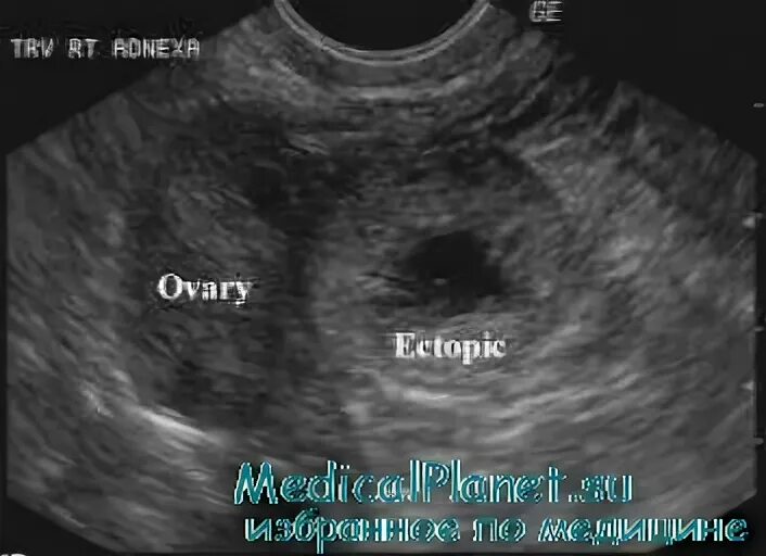 Внематочная беременность на УЗИ. Внематочная УЗИ картина. УЗИ картина беременности. Внематочная беременность на УЗИ фото.