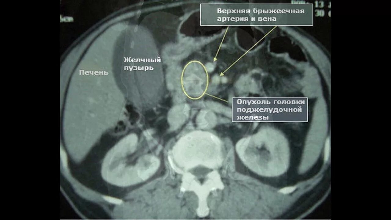 Карцинома поджелудочной железы кт. Опухоль головки поджелудочной железы мрт. Контрастирование поджелудочной железы кт. Поджелудочная железа на кт снимке. На кт видно опухоль