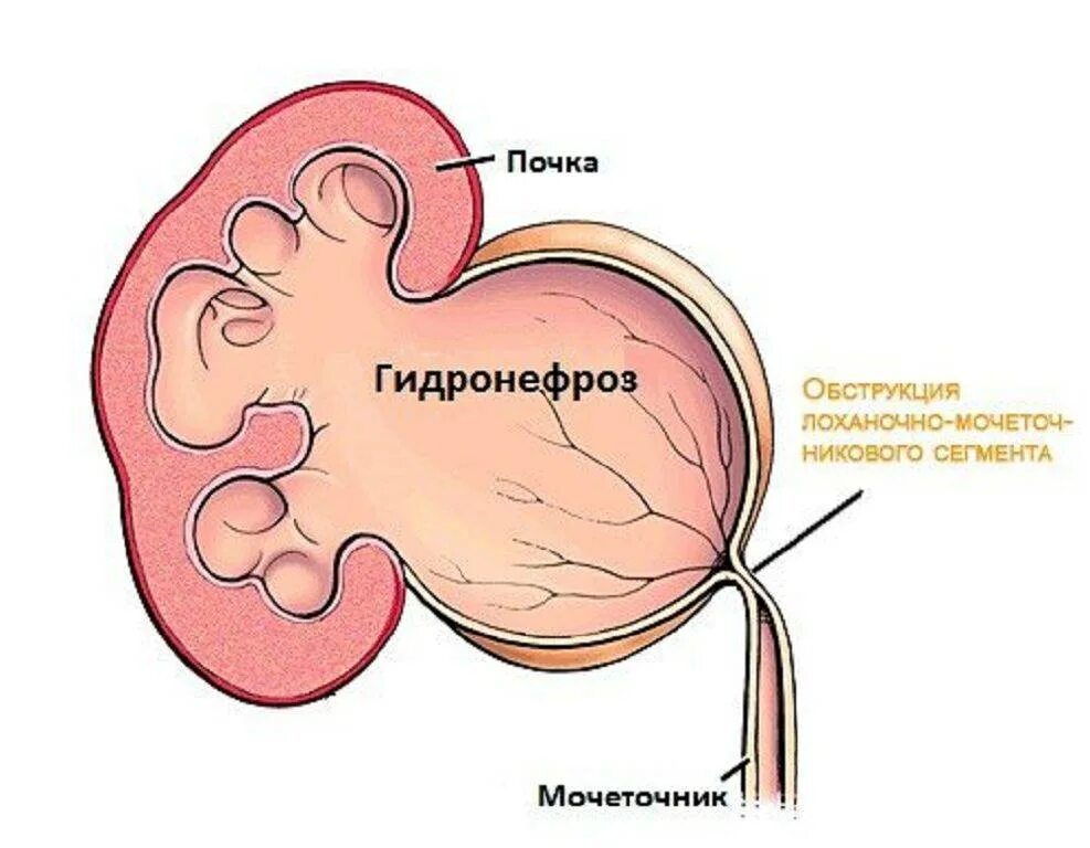 Почему увеличена почка