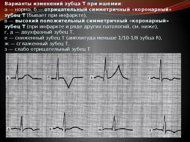 Отрицательные зубцы т на ЭКГ В v2 v5. ЭКГ отрицательный зубец т в v1-v3. Отрицательный зубец t в 3 отведении на ЭКГ. Отрицательный зубец т на ЭКГ В v1 v2. Неспецифические изменения нижней стенки