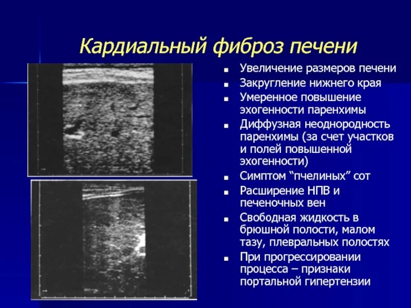 Диффузное снижение плотности. Фиброз печени на УЗИ признаки. УЗИ признаки кардиального фиброза. Кардиальный фиброз печени на УЗИ.