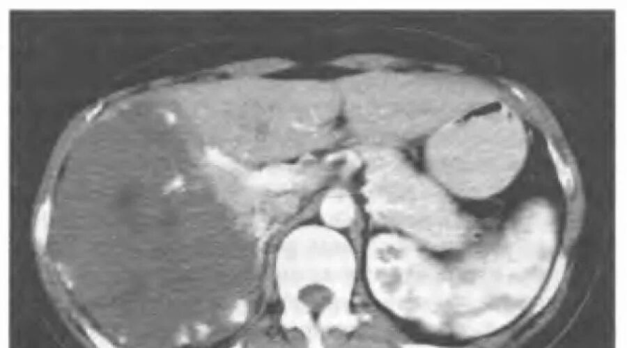 Кавернозная гемангиома печени кт. Гигантская кавернозная гемангиома печени кт. Атипичная гемангиома печени на кт. Очаговые гемангиомы печени